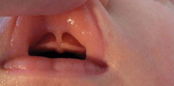 lip tie - Frenectomy
