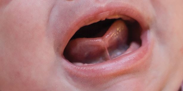 tongue tie - Frenectomy